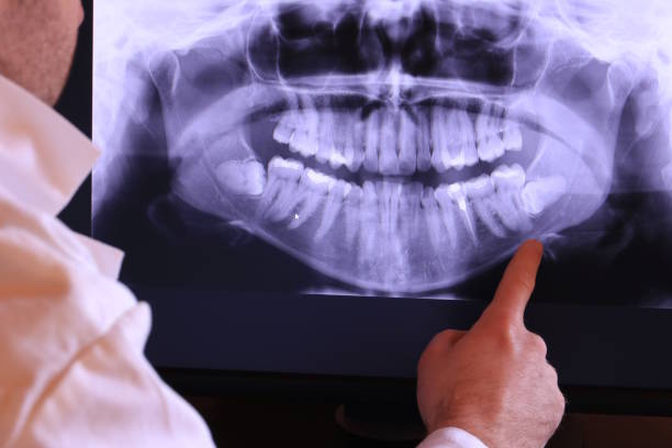Best Emergency Tooth Extraction in Quinnesec, MI