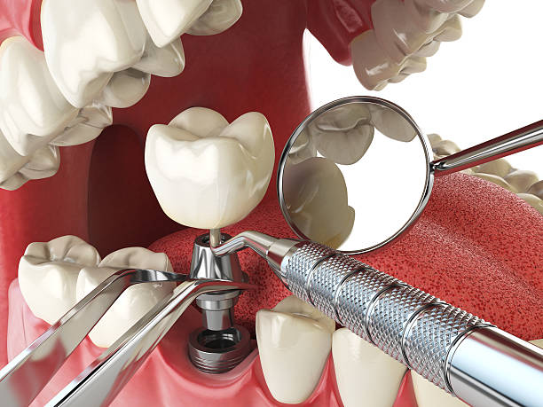 Best Emergency Root Canal Treatment in Quinnesec, MI