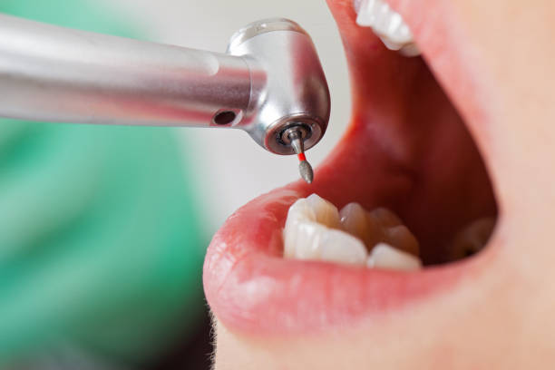 Best Emergency Tooth Extraction in Quinnesec, MI